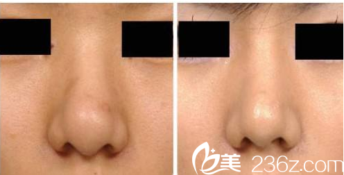 韩国ITEM(爱婷)整形医院案例 韩国ITEM(爱婷)整形医院案例