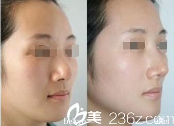 韩国ITEM(爱婷)整形医院案例 韩国ITEM(爱婷)整形医院案例