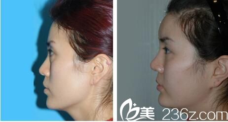 韩国朴宰佑整形外科美容医院自体脂肪移植案例 韩国朴宰佑整形外科美容医院自体脂肪移植案例