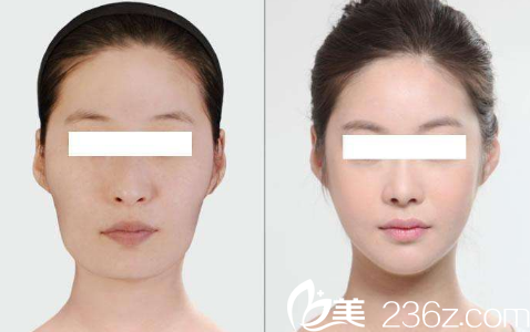 韩国ITEM（爱婷）整形医院案例