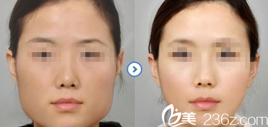 韩国ITEM（爱婷）整形医院案例