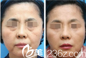 韩国ITEM(爱婷)整形医院案例 韩国ITEM(爱婷)整形医院案例