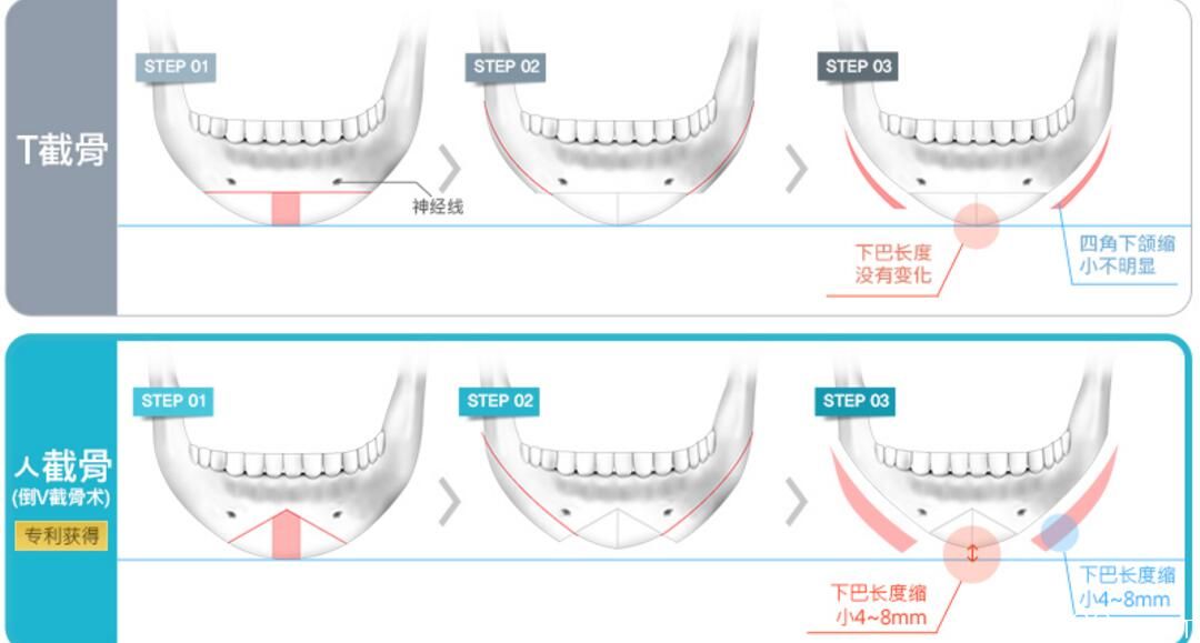V-line四角下颌手术 V-line四角下颌手术