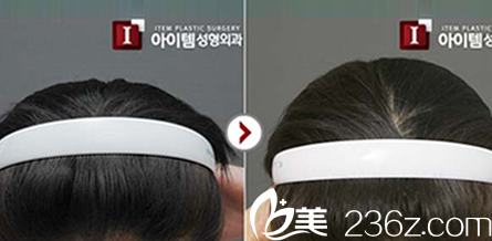 韩国ITEM(爱婷)整形医院案例 韩国ITEM(爱婷)整形医院案例