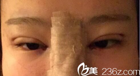  韩国朴宰佑整形外科朴宰佑真人案例图2