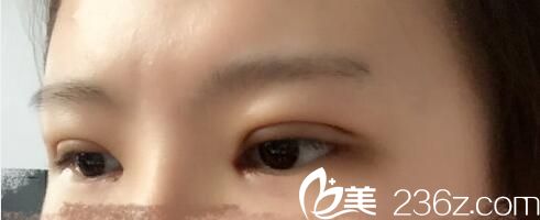  韩国朴宰佑整形外科朴宰佑真人案例图5