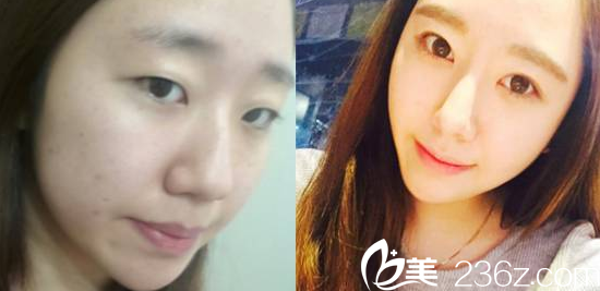 真人案例告诉你在韩国贝缇莱茵医院隆鼻和割双眼皮怎么样？多少钱？