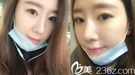 韩国贝缇莱茵医院隆鼻和割双眼皮真人案例4