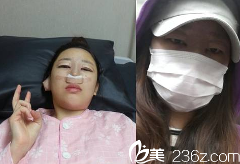 韩国贝缇莱茵医院隆鼻和割双眼皮真人案例3