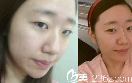 韩国贝缇莱茵医院隆鼻和割双眼皮真人案例12