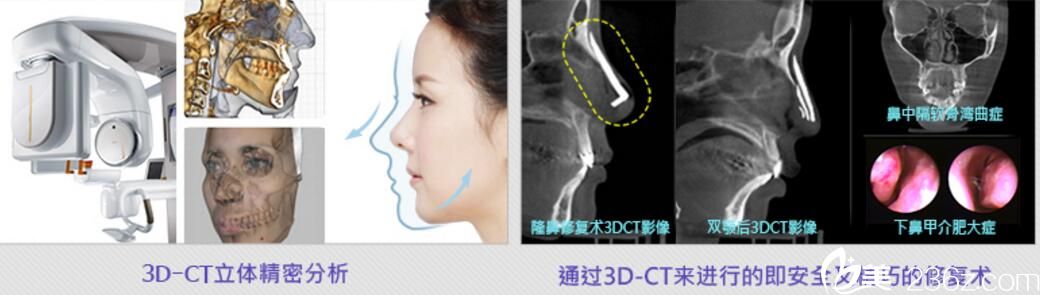 利用3D-CT完成双鄂手术后的鼻整形、突嘴整形 利用3D-CT完成双鄂手术后的鼻整形、突嘴整形