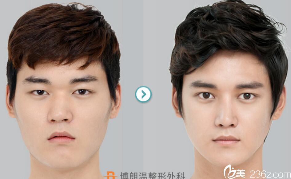 金贵洛院长鼻整形案例 金贵洛院长鼻整形案例