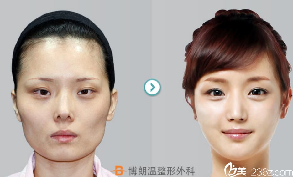 金贵洛院长鼻修复案例 金贵洛院长鼻修复案例