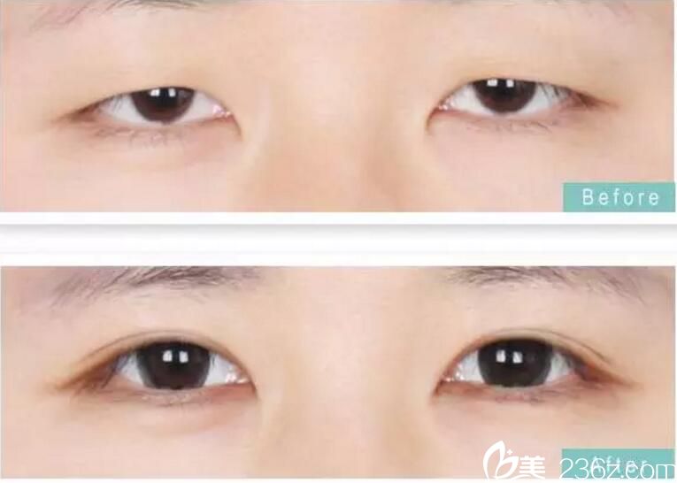 徐辅翊双眼皮案例