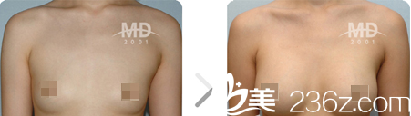 韩国MD胸部整形医院案例 韩国MD胸部整形医院案例