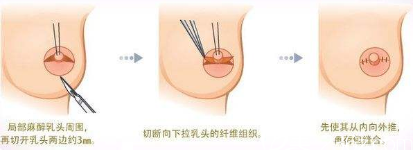 韩国MD胸部整形医院宣传图 韩国MD胸部整形医院宣传图