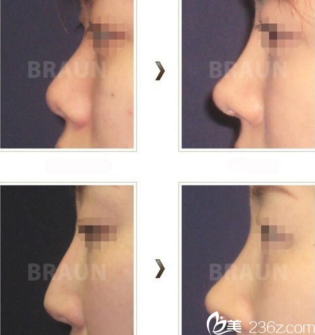 朴光珉鼻整形案例