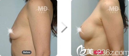 韩国MD胸部整形医院案例