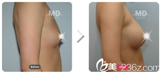 韩国MD胸部整形医院案例