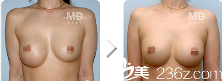 韩国MD医院胸部整形怎么样？胸部修复多少钱？李相达院长案例