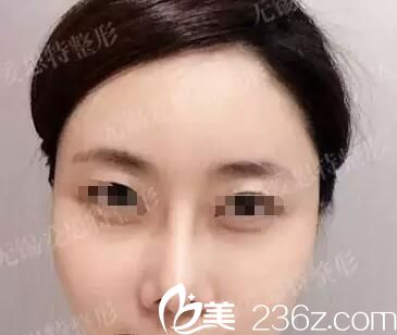 隆鼻失败鼻型太假案例 隆鼻失败鼻型太假案例