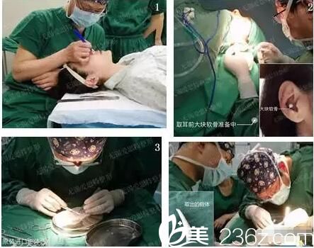 鼻综合修复隆鼻失败 鼻综合修复隆鼻失败