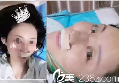 欧阳黎平医生隆鼻失败修复术后即刻 欧阳黎平医生隆鼻失败修复术后即刻