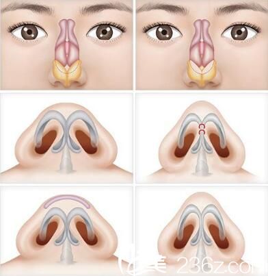 韩国Romian路美颜整形医院鼻尖矫正 韩国Romian路美颜整形医院鼻尖矫正