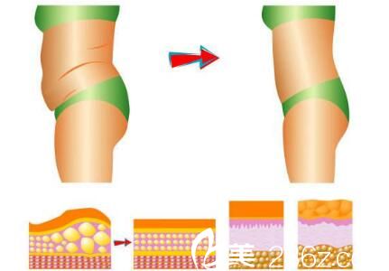 韩国Romian路美颜整形医院吸脂图