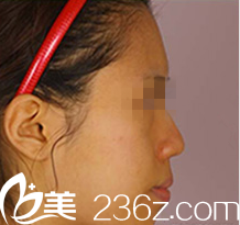 韩国ITEM(爱婷)整形医院案例 韩国ITEM(爱婷)整形医院案例