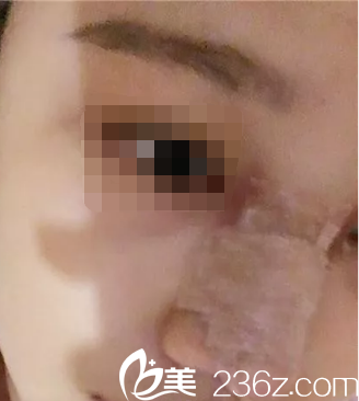 韩国ITEM(爱婷)整形医院案例 韩国ITEM(爱婷)整形医院案例