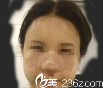 韩国ITEM(爱婷)整形医院案例 韩国ITEM(爱婷)整形医院案例