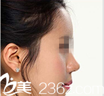 在韩国ITEM（爱婷）花26000元做硅胶隆鼻一个月，郑宇振院长案例