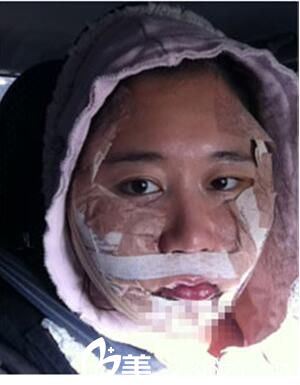 韩国Romian路美颜整形医院真人案例图2 韩国Romian路美颜整形医院真人案例图2