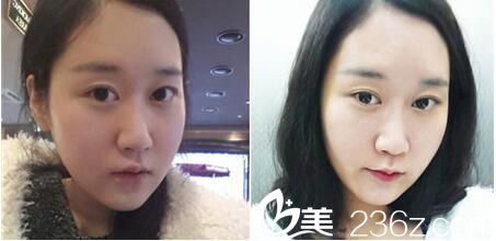 韩国Romian路美颜整形医院真人案例图5 韩国Romian路美颜整形医院真人案例图5