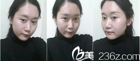 韩国Romian路美颜整形医院真人案例图4 韩国Romian路美颜整形医院真人案例图4