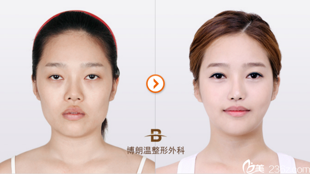 韩国博朗温整形外科医院面部轮廓真人案例
