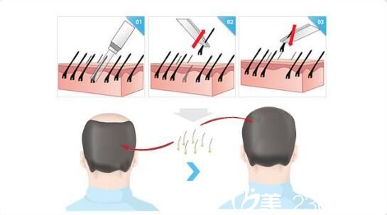 韩国RUBY如妃整形外科医院毛发移植 韩国RUBY如妃整形外科医院毛发移植