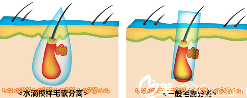 JJ洪镇柱整形外科毛发移植怎么样？多少钱？