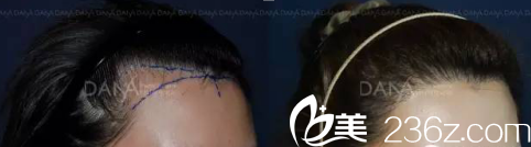 JJ洪镇柱整形外科毛发移植案例
