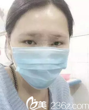 韩国opera整形医院金锡汉院长做假体垫下巴3 韩国opera整形医院金锡汉院长做假体垫下巴3