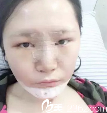 韩国opera整形医院金锡汉院长做假体垫下巴2 韩国opera整形医院金锡汉院长做假体垫下巴2