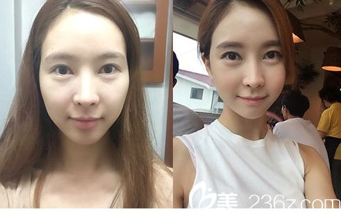 洪镇柱医生做轮廓手术怎么样？用我的亲身经历来证明洪镇柱医生技术厉害