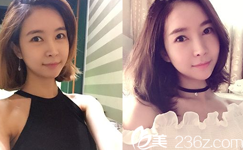 韩国JJ洪镇柱整形医院洪镇柱做轮廓手术真人<span style= 韩国JJ洪镇柱整形医院洪镇柱做轮廓手术真人<span style=