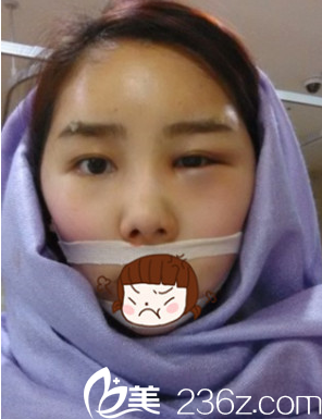 韩国JJ洪镇柱整形医院洪镇柱做轮廓手术真人<span style= 韩国JJ洪镇柱整形医院洪镇柱做轮廓手术真人<span style=