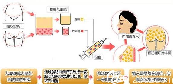 自体脂肪填充原理