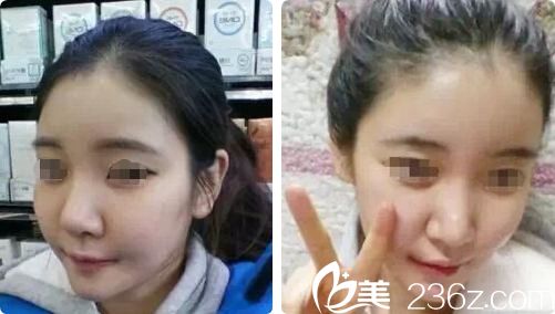 首次面部脂肪填充术后效果