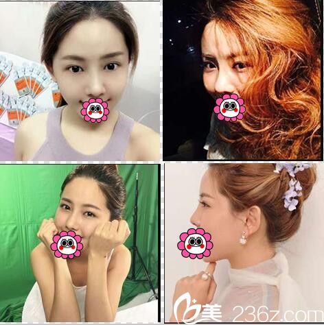 看我在欧菲整形找袁纯新医生做膨体隆鼻的恢复效果好不好