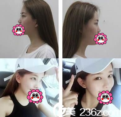 欧菲隆鼻23天效果对比 欧菲隆鼻23天效果对比