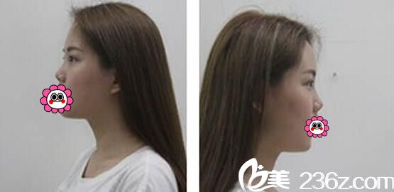 <!--<i data=20240703-sp></i>-->欧菲整形隆鼻前 <!--<i data=20240703-sp></i>-->欧菲整形隆鼻前